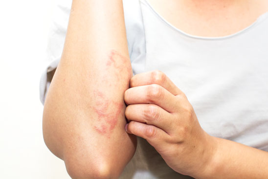 Water softeners in Essex can reduce the negative effects that cause dry skin and irritations such as eczema
